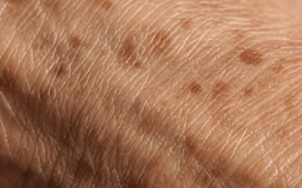Human age spots