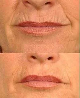 Anti aging, Rejuvenation, rejuvenecimiento