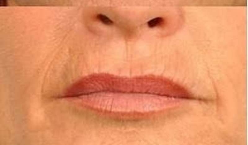 Rejuvenation, Anti aging, rejuvenecimiento