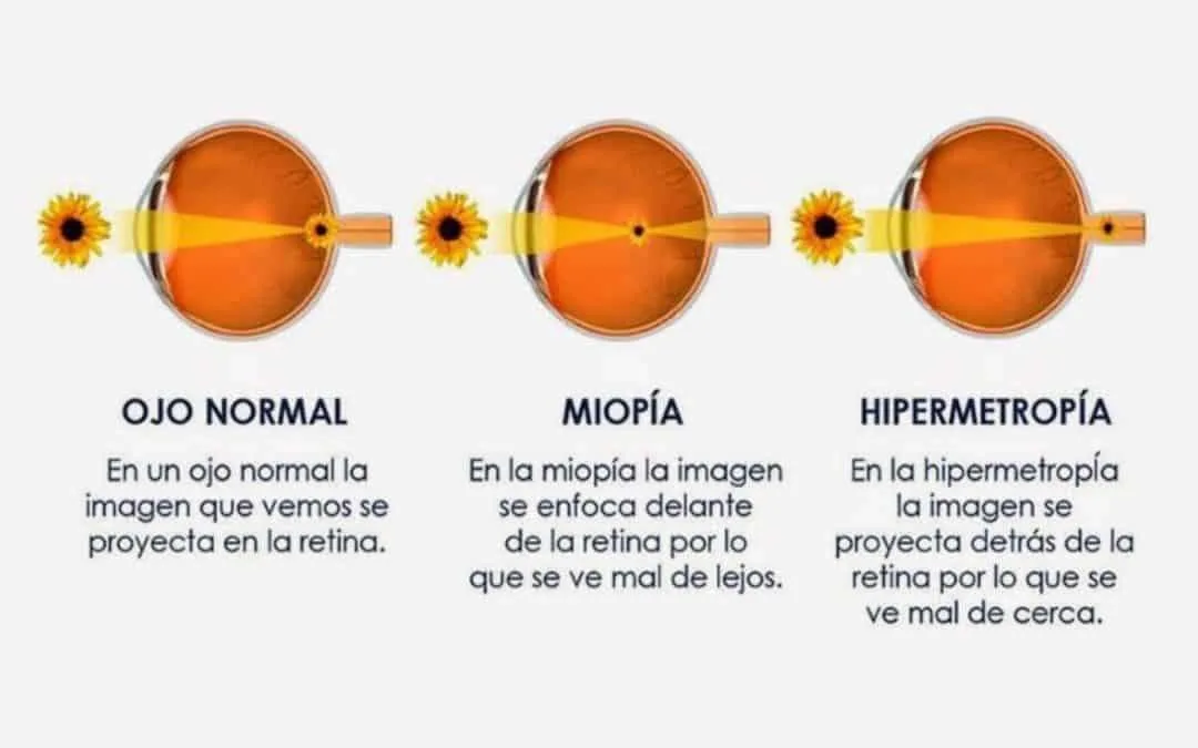 Refractive defects Myopia, hyperopia, and astigmatism - miopía