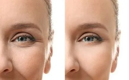 Mikronadel-, Dermapen- oder Kollagen-Induktionstherapie